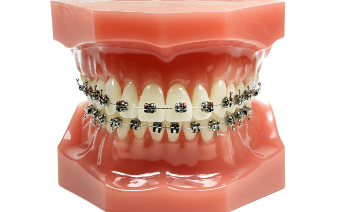 How Much Do Braces Cost? A Comprehensive Guide