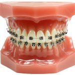 how much do braces cost