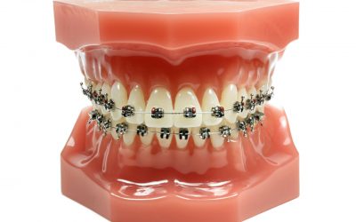 How Much Do Braces Cost? A Comprehensive Guide