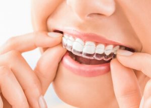 Invisalign dental treatment