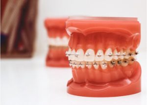 traditional metal braces