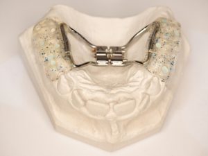 Common side effects of palate expanders Common side effects of palate expanders
