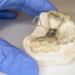 how much does a palate expander cost