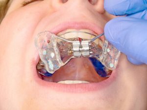 Does insurance cover palate expanders