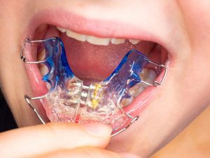 How much does a palate expander cost How much does a palate expander cost