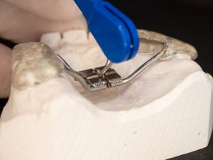will palate expanders change my face