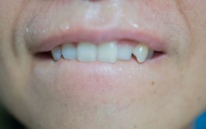 sharp canine teeth